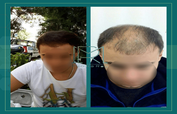 Sapphire Hair Transplant