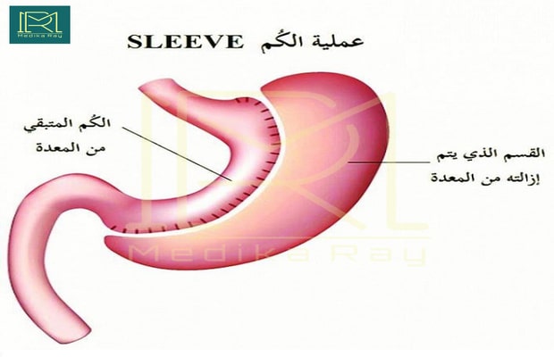 تكميم المعدة