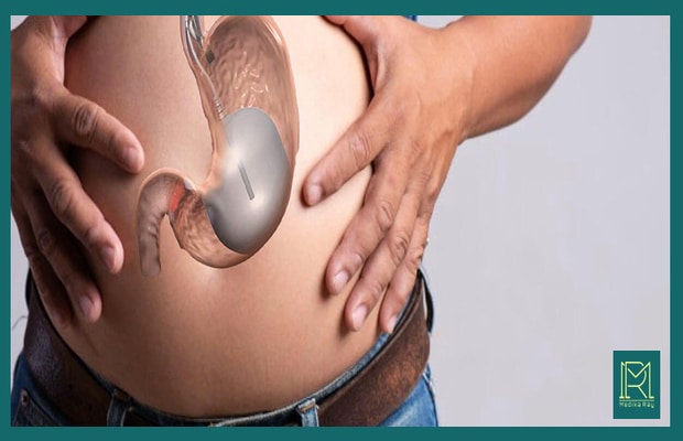 Gastric Balloon